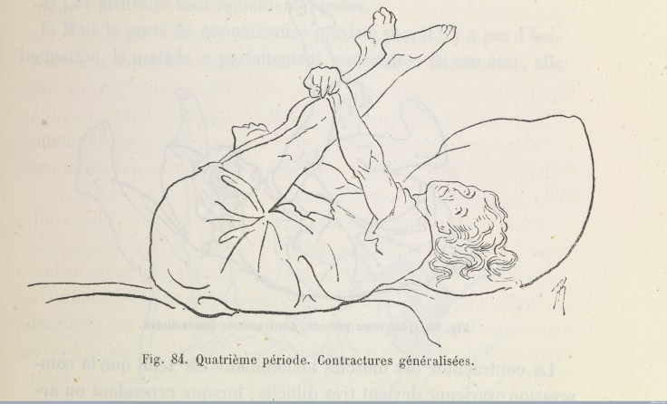  Études cliniques sur l'hystéro-épilepsie ou grande hystérieCredit: Wellcome Library, London. Wellcome Imagesimages@wellcome.ac.ukhttp://wellcomeimages.orgÉtudes cliniques sur l'hystéro-épilepsie ou grande hystérie. Epilepsy.1881 Études cliniques sur l'hystéro-épilepsie ou grande hystérie /Paul Marie Louis Pierre RicherPublished: 1881Copyrighted work available under Creative Commons Attribution only licence CC BY 4.0 http://creativecommons.org/licenses/by/4.0/